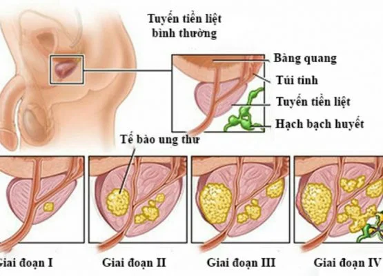 bệnh nam khoa
