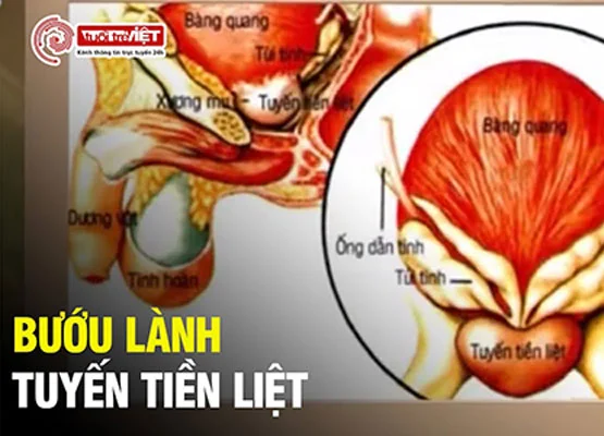 bệnh nam khoa