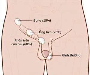 Mô hình biểu diễn các vị trí tinh hoàn ẩn (tham khảo)